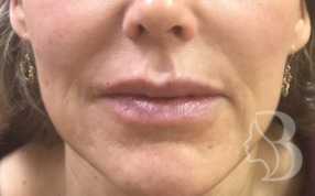 Lip Filler - Restylane Silk after