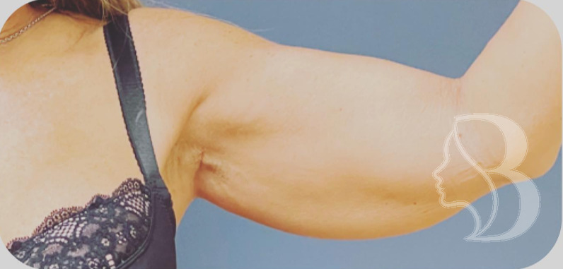 Arm Lift before