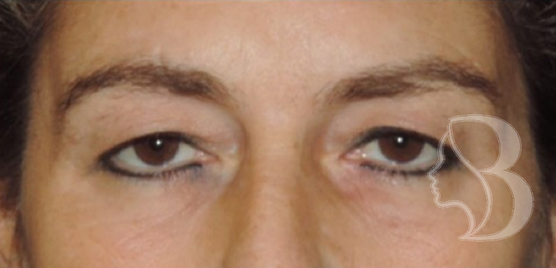 Upper Blepharoplasty before