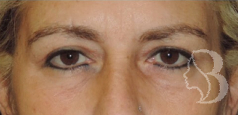Upper Blepharoplasty after