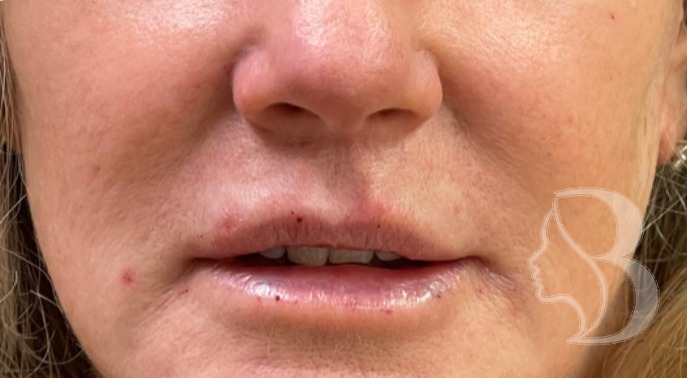 Lip Filler - Philtral Columns after