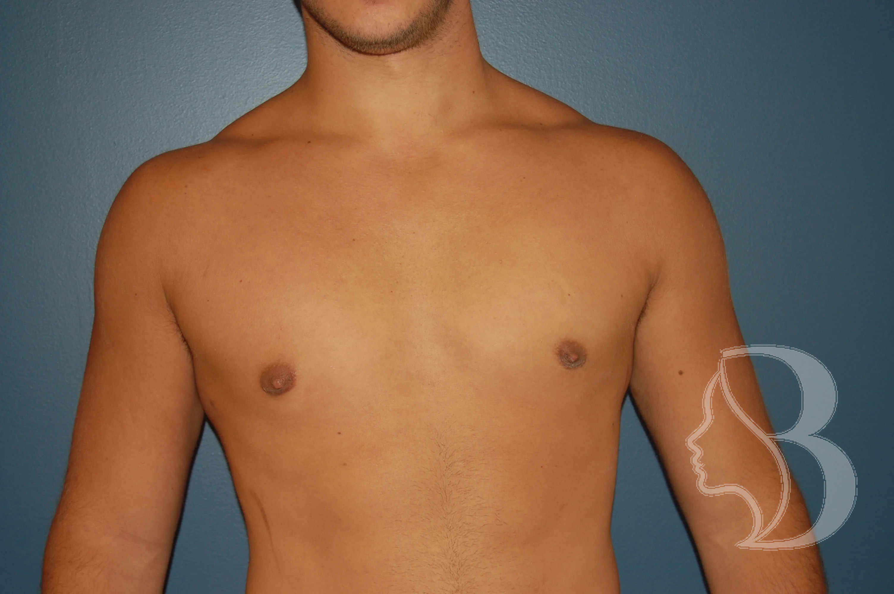 Male Breast Reduction after