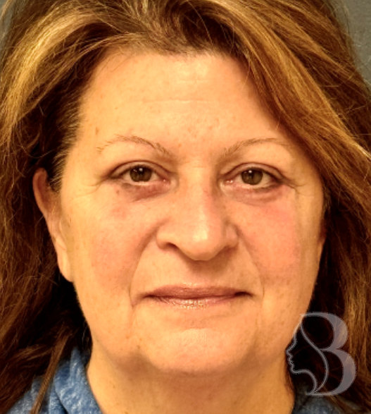 Lower Blepharoplasty, Rafi Stitch, Fat Transposition after