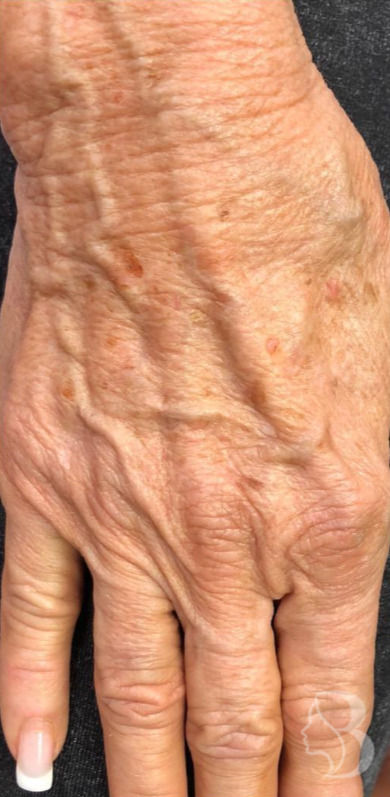 Hand Rejuvenation - Restylane Lyft before