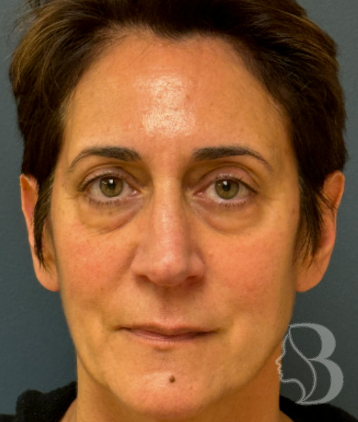 Lower Blepharoplasty, Rafi Stitch, Fat Transposition before