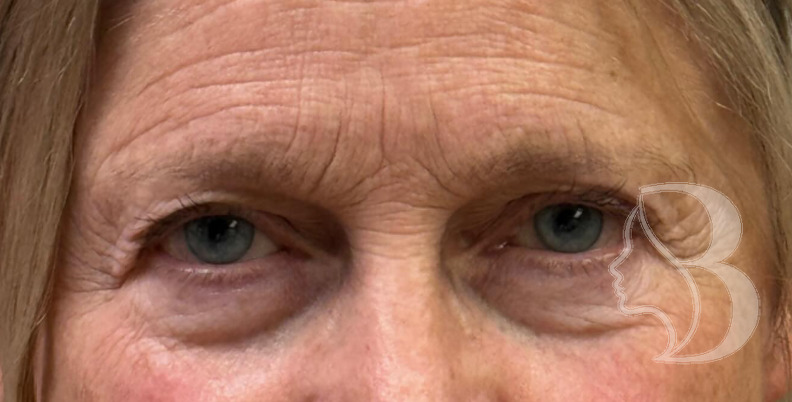 Dysport - Brow Lift before