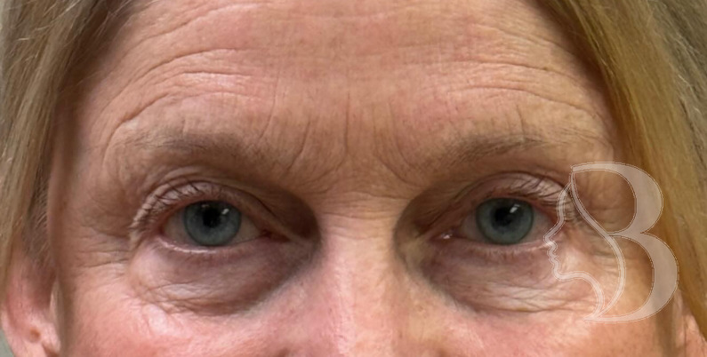 Dysport - Brow Lift after