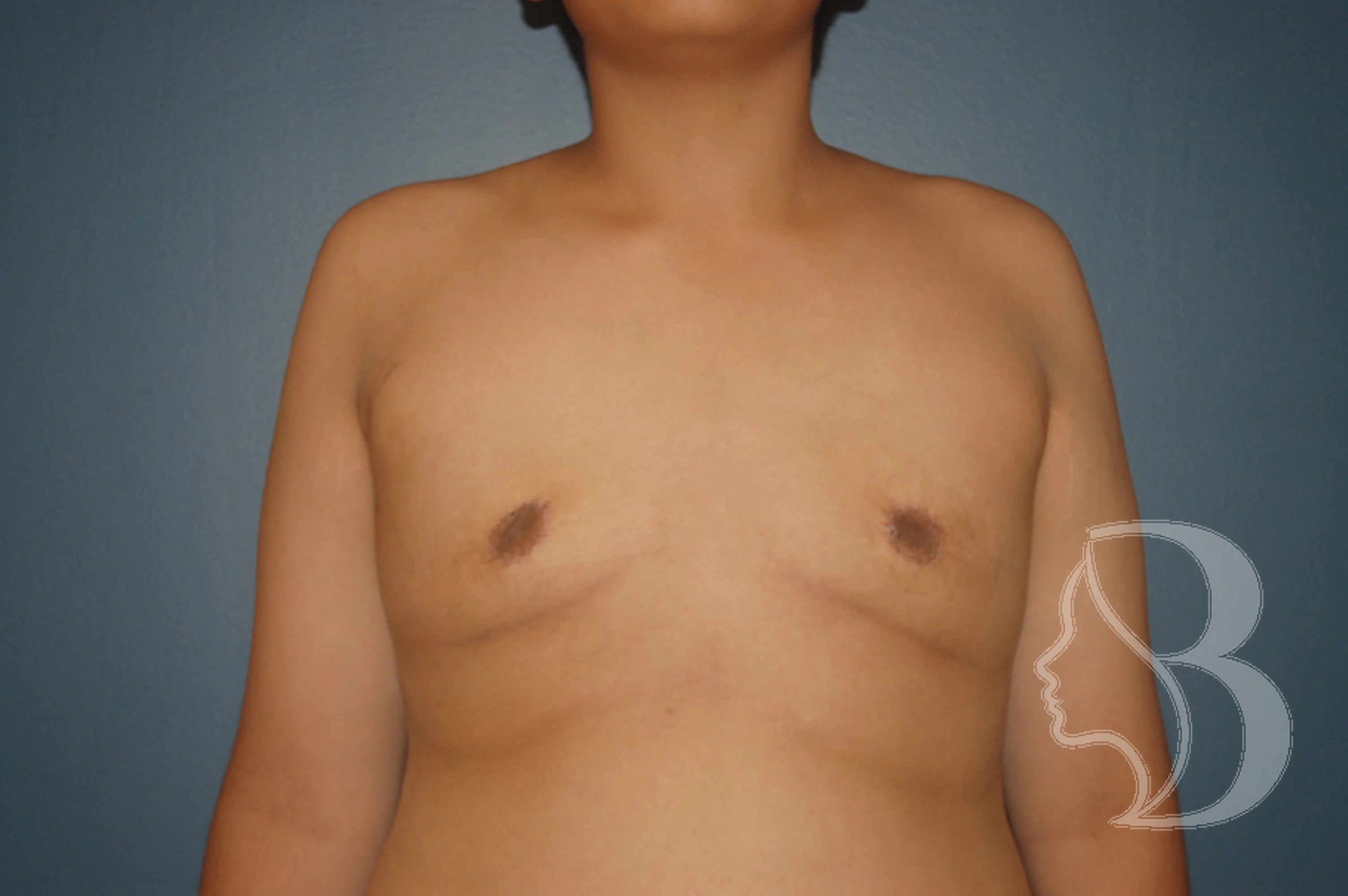 Male Breast Reduction after