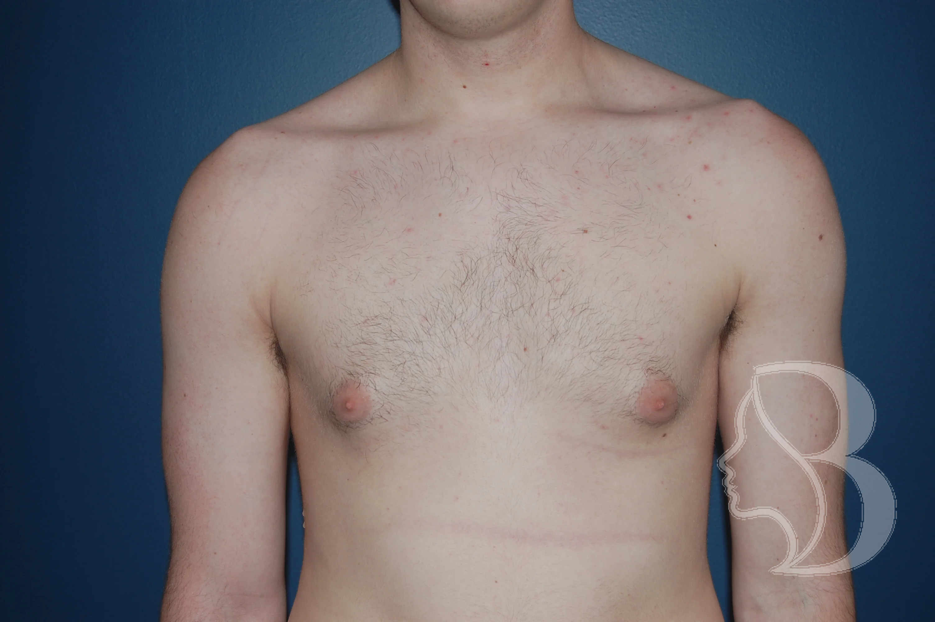 Male Breast Reduction before