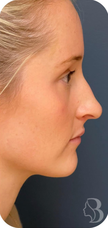 Rhinoplasty before