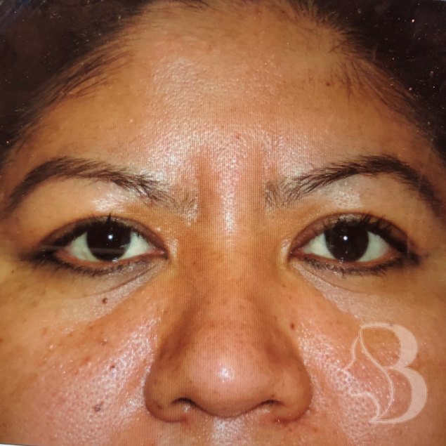 Glabellar Filler - Restylane before