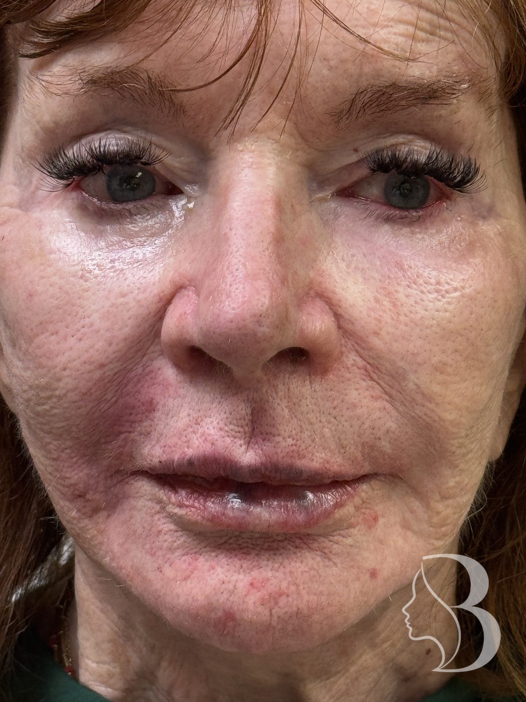Lip, philtral column, nasolabial fold and cheek filler with Restylane Kysse and Lyft — after