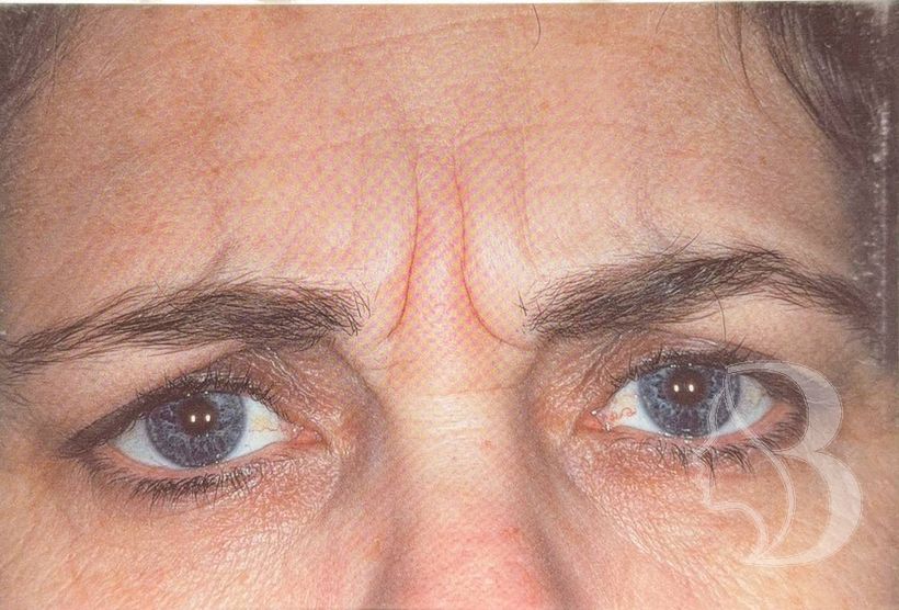 Frown lines (glabella) before neuromodulator treatment