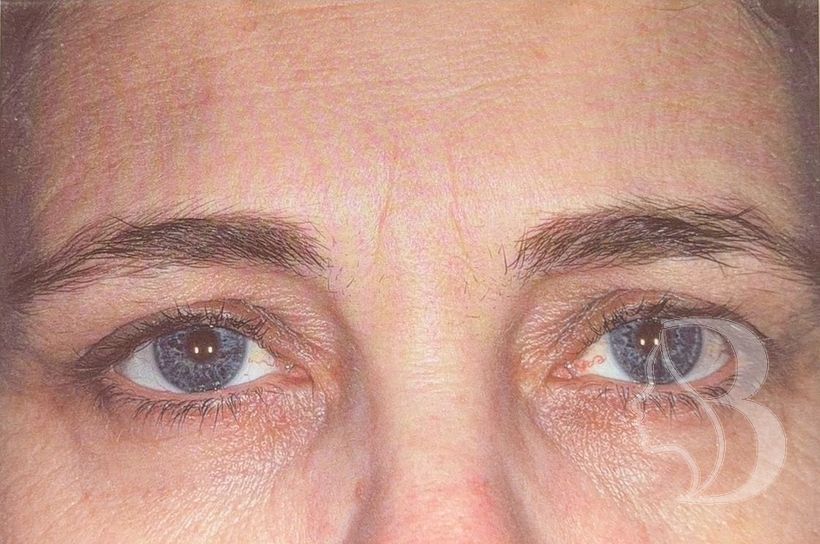 Frown lines (glabella) after neuromodulator treatment