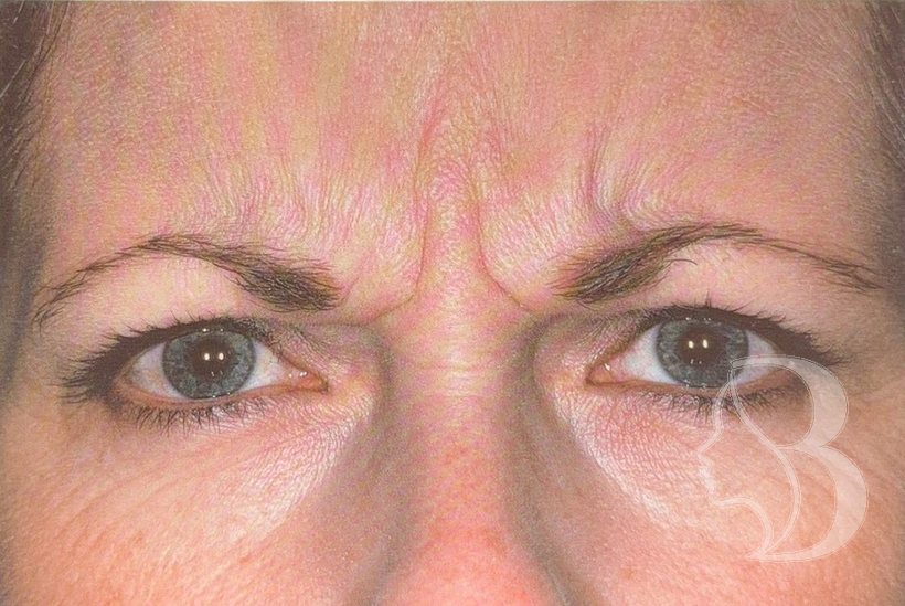 Frown lines (glabella) before neuromodulator treatment