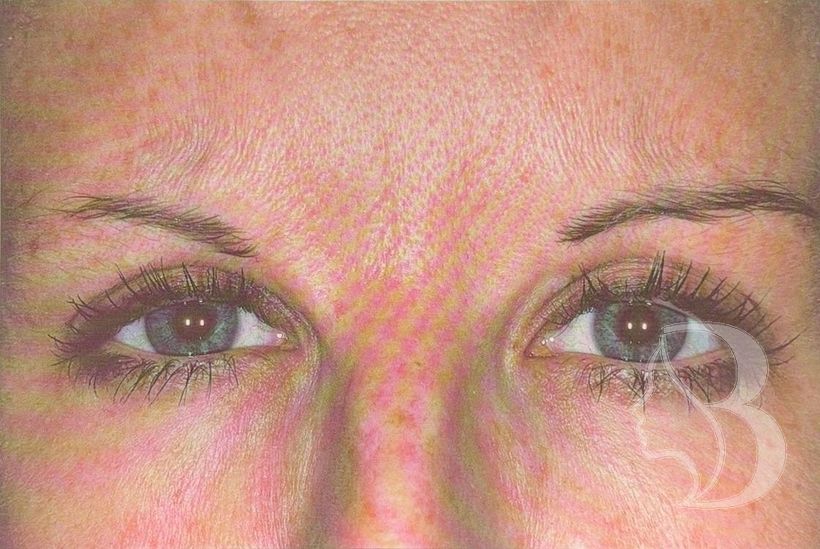 Frown lines (glabella) before neuromodulator treatment