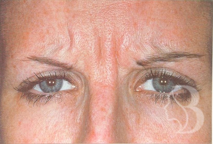 Frown lines (glabella) after neuromodulator treatment