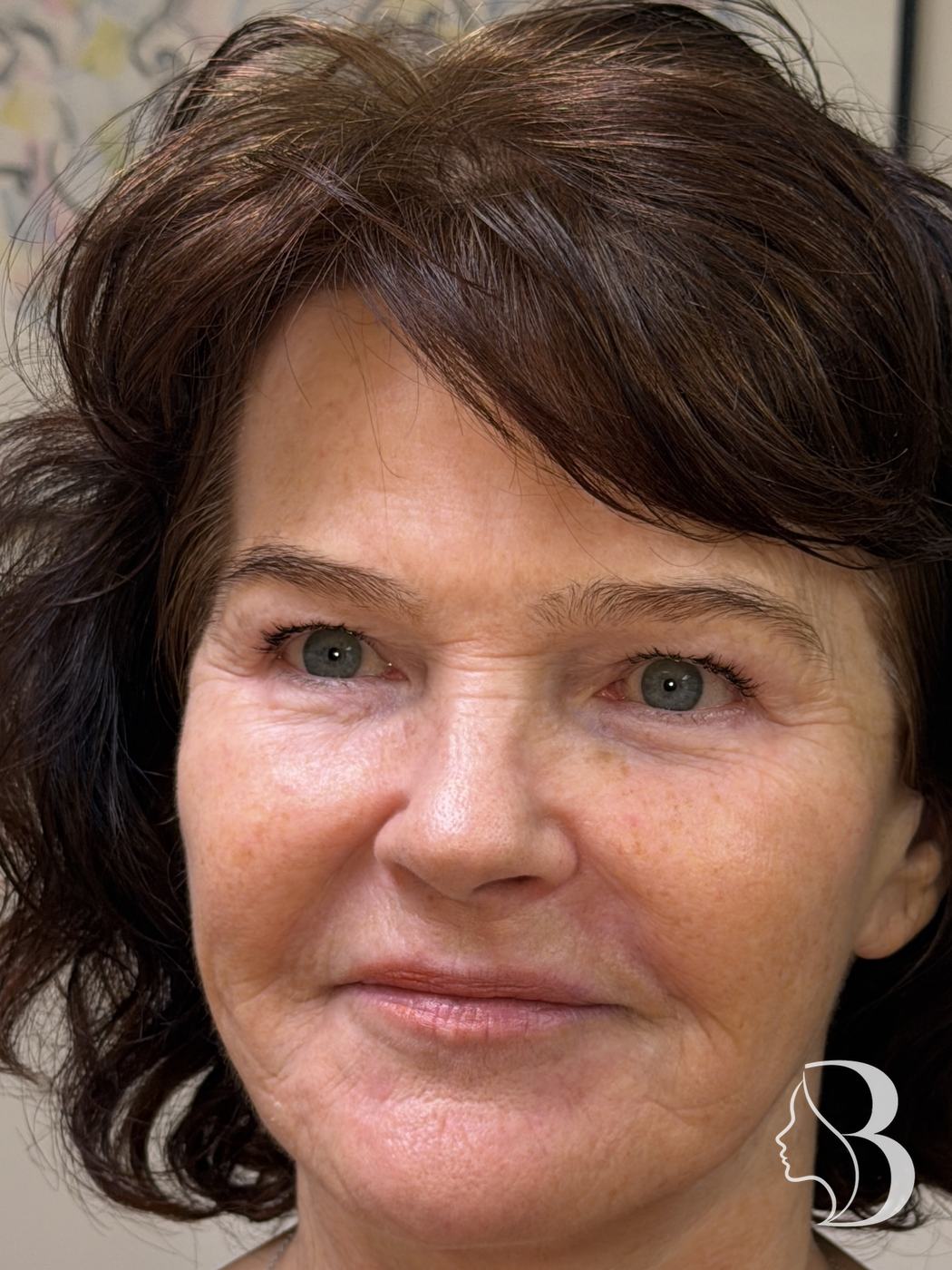 Lip filler for volume and perioral line softening with Restylane, plus Dysport lip flip, crow's feet and brow, before