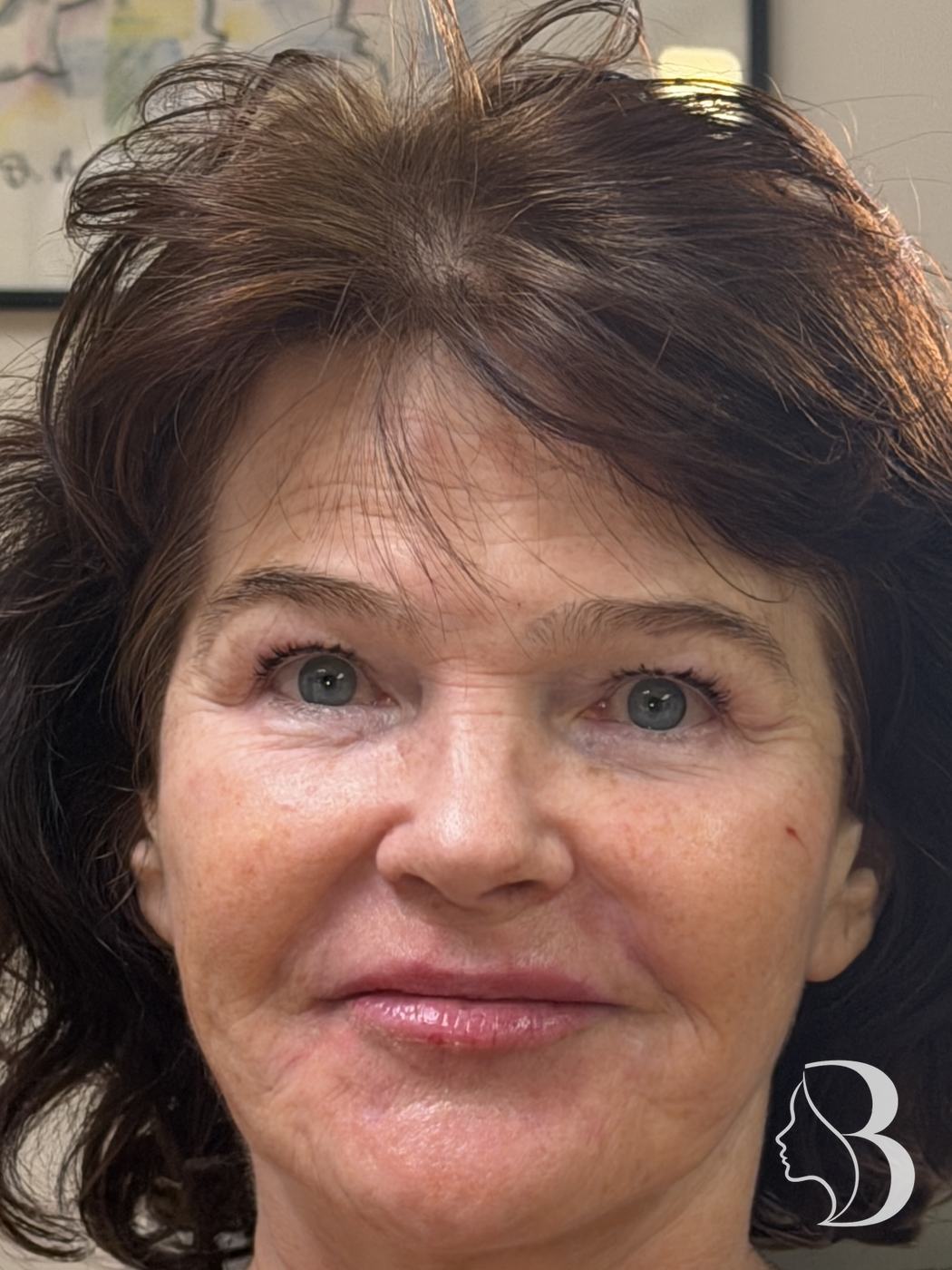Lip filler for volume and perioral line softening with Restylane, plus Dysport lip flip, crow's feet and brow, after