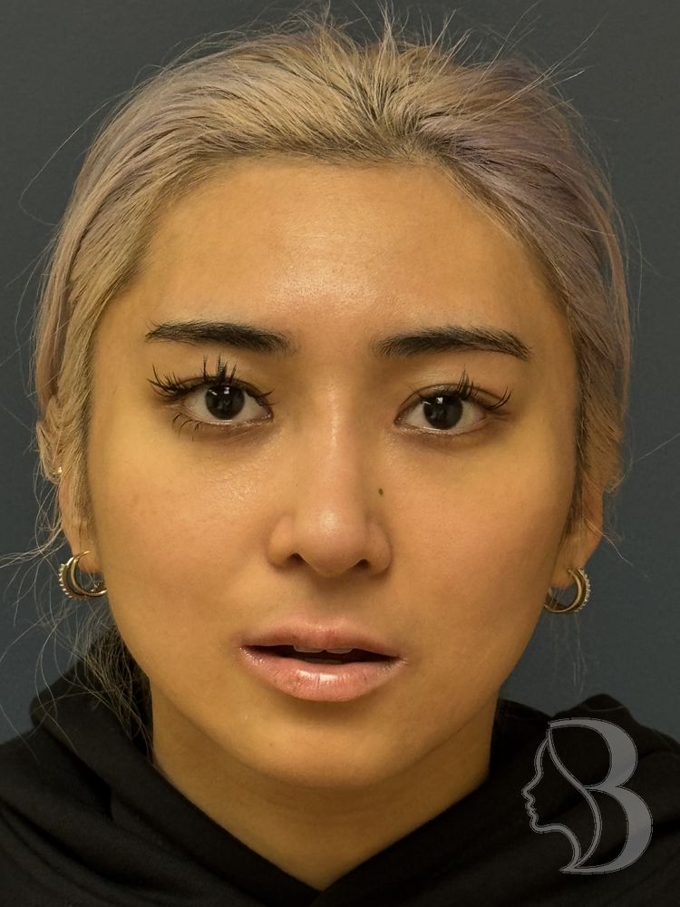 Revision rhinoplasty and lip lift before