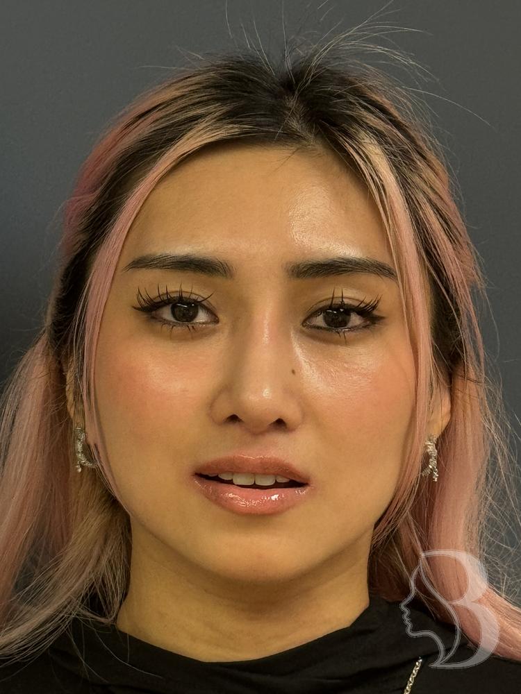 Revision rhinoplasty and lip lift after