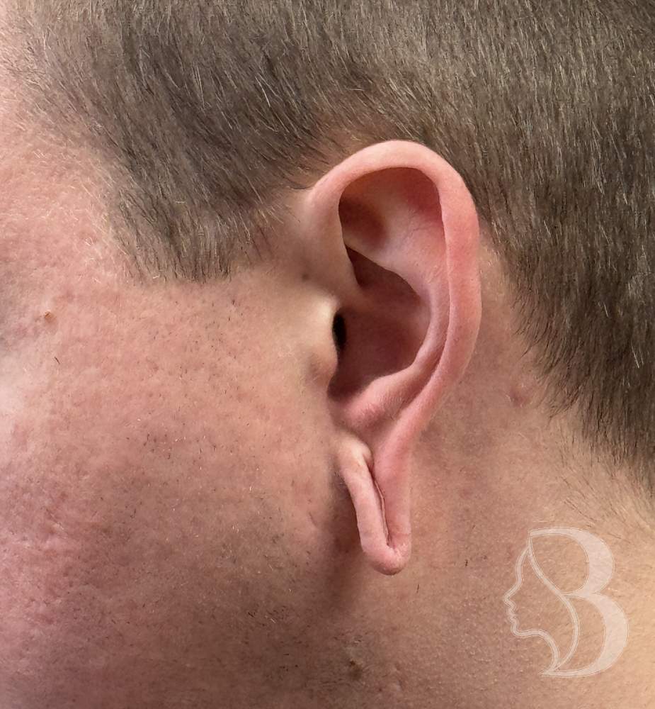 Gauged earlobe repair before