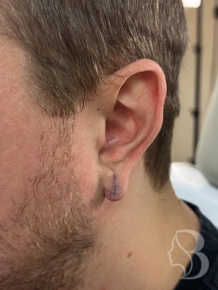 Gauged earlobe repair after, with sutures