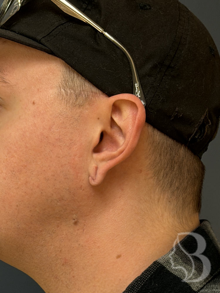 Gauged earlobe after repair, healed &mdash; reconstructed lobule