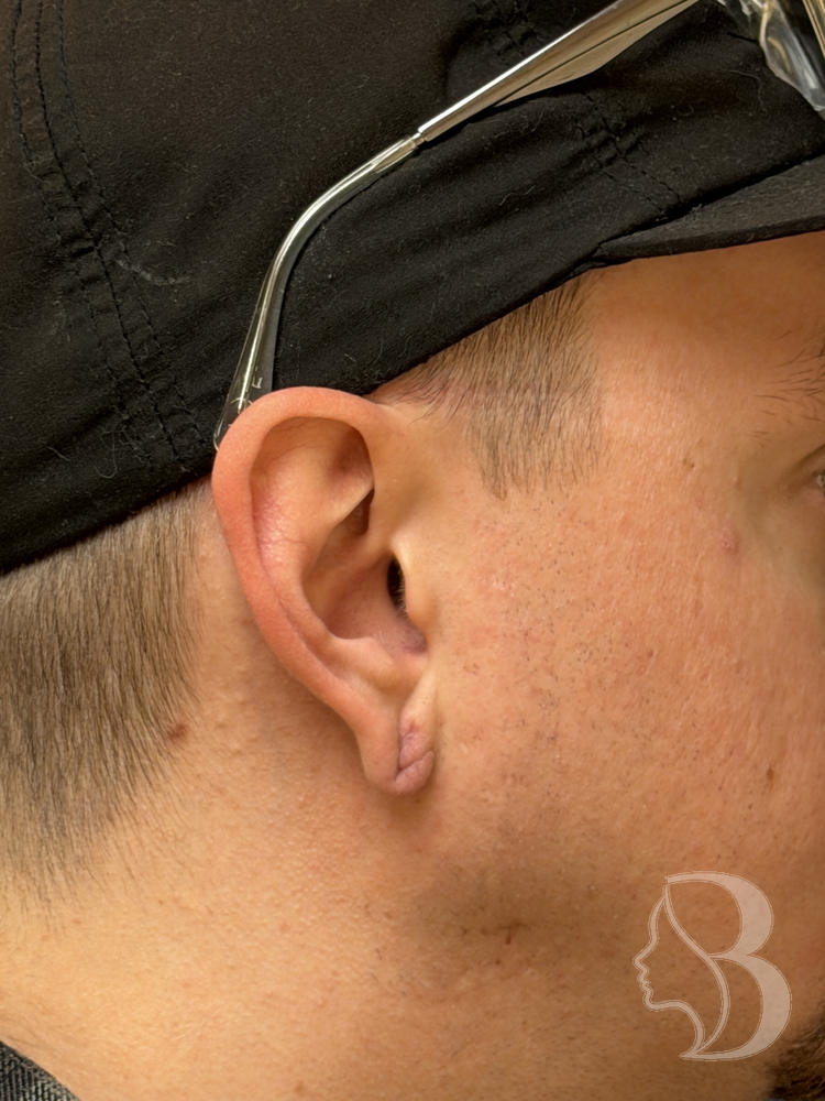 Gauged earlobe after repair, healed &mdash; reconstructed lobule, second view