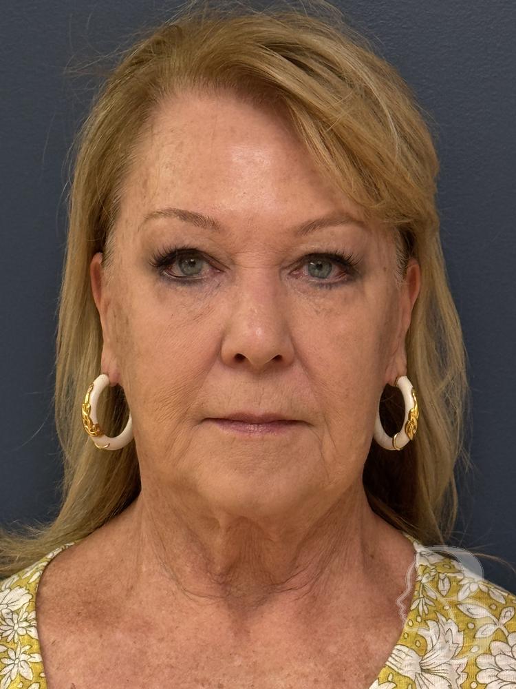 SMAS facelift before &mdash; Morristown NJ patient of Dr. Rafizadeh