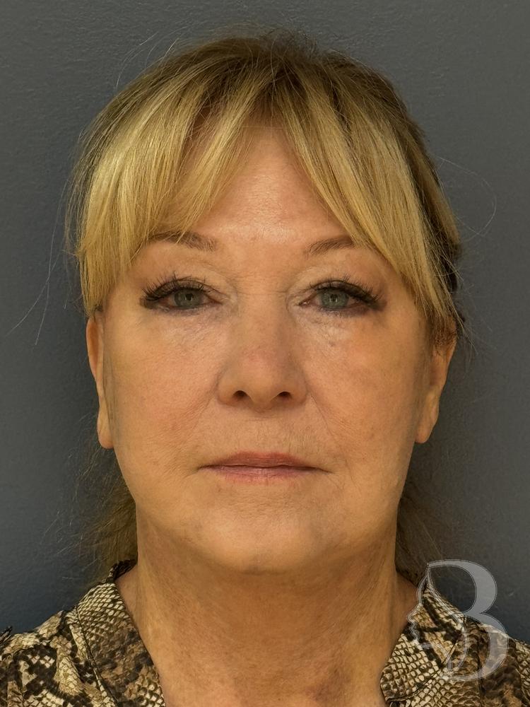 SMAS facelift after &mdash; tighter jawline and neck by Dr. Rafizadeh
