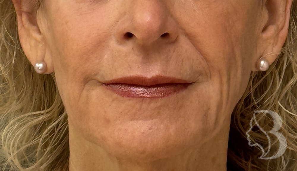 Lip lift before &mdash; long philtrum and thin upper lip, Morristown NJ patient of Dr. Rafizadeh