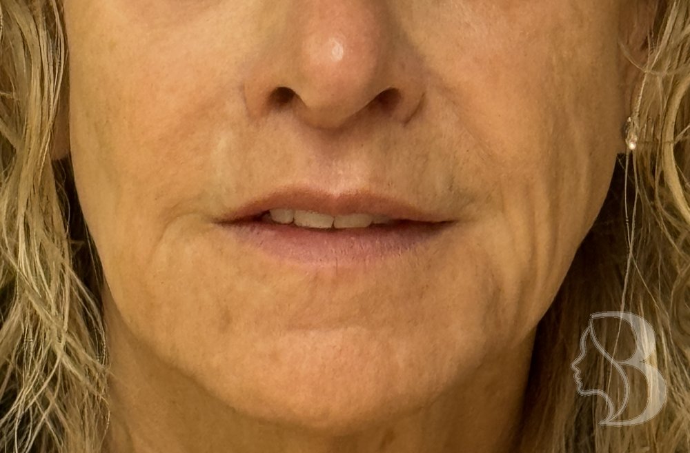 Lip lift after &mdash; shortened philtrum with more upper lip and tooth show by Dr. Rafizadeh