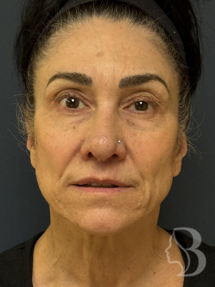 SMAS facelift before &mdash; Morristown NJ patient of Dr. Rafizadeh