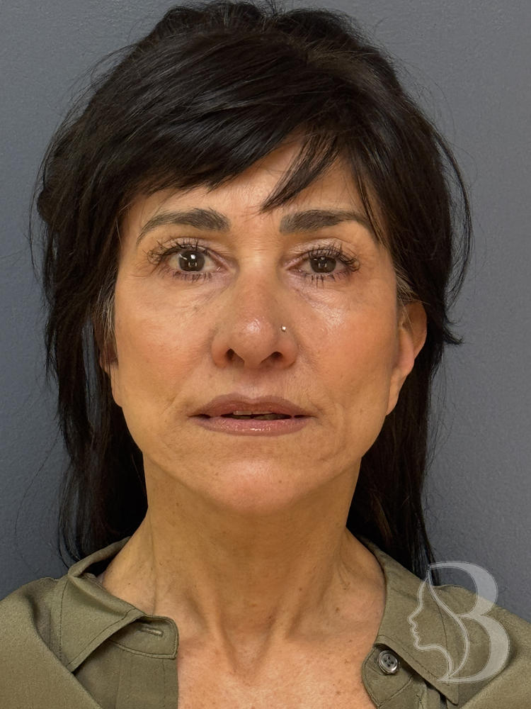 SMAS facelift after &mdash; tighter jawline and neck by Dr. Rafizadeh
