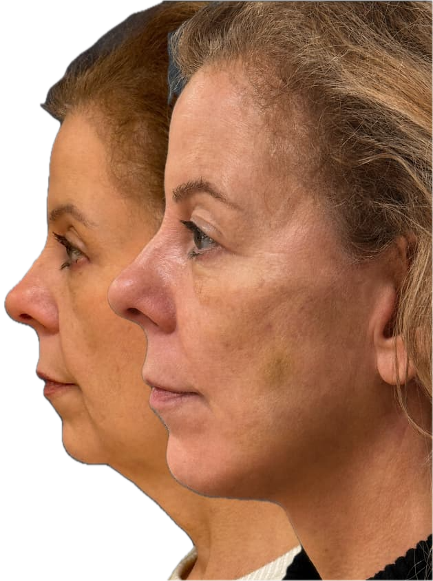 Deep plane facelift patient at 1 week post-op — before and after profile view, Dr. Rafizadeh Morristown NJ