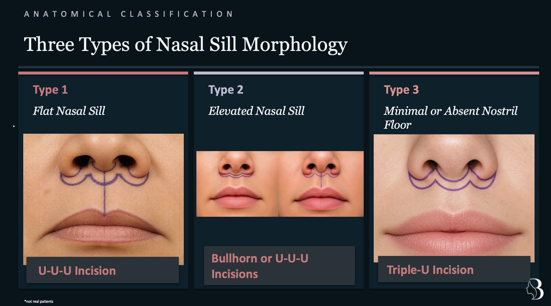 Three types of nasal sill morphology — Type 1 Flat, Type 2 Elevated, Type 3 Absent — with corresponding lip lift incision designs