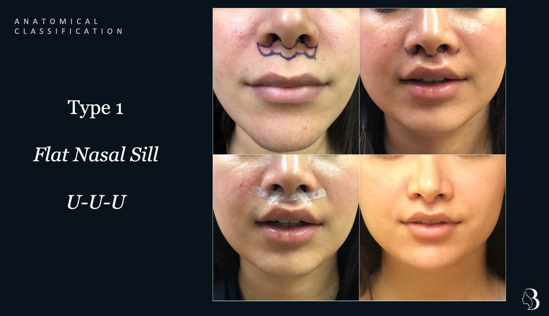 Type 1 flat nasal sill — modified U-U-U incision lip lift, before and after