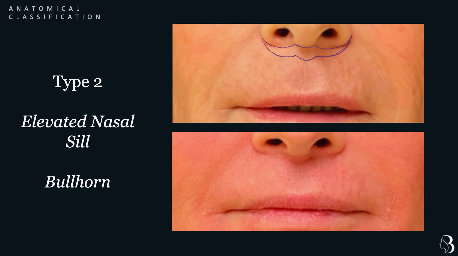 Type 2 elevated nasal sill — classic bullhorn subnasal lip lift, before and after