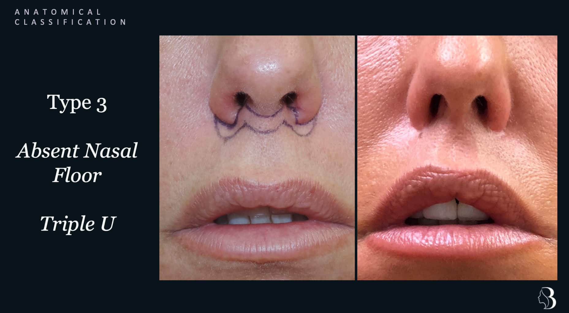 Type 3 absent nasal floor — triple-U variation lip lift, before and after