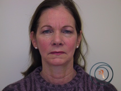 Before Photo of patient going for facelift brow lift and eyelids by Dr Rafizadeh Morristown N.J.
