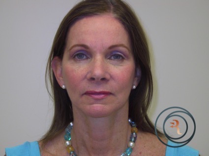 After Photo facelift brow lift eyelid surgery performed by Dr. Rafizadeh Morristown N.J.