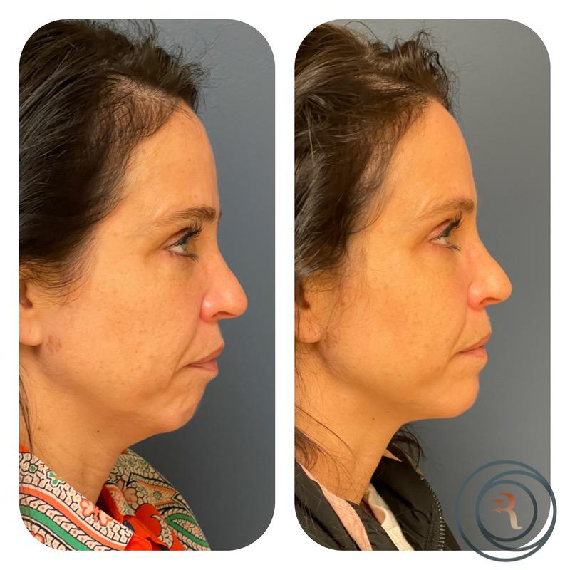 chin implant before and after photo
